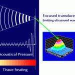 HIFU High Intensity Focused Ultrasound